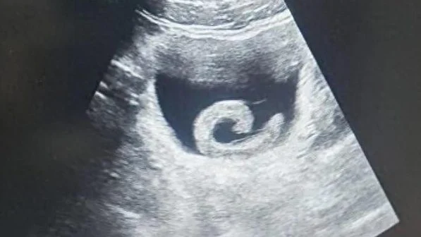 听信偏方 男子将5厘米长水蛭从尿道塞入膀胱